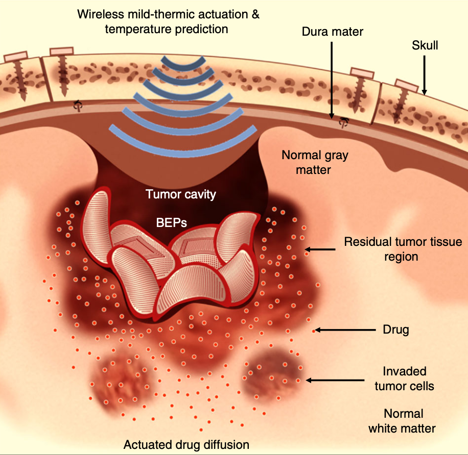 Intracranial Drug Delivery